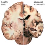 Alzheimer