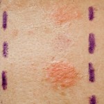Skin Allergy Patch Test on Back of Patient