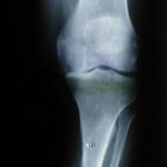 arthritis