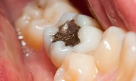 Are Mercury Fillings Toxic?