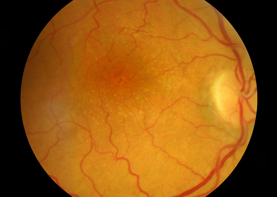 Macular Degeneration, Sunlight and Antioxidants