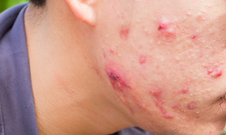 Acne and Vitamins A & E
