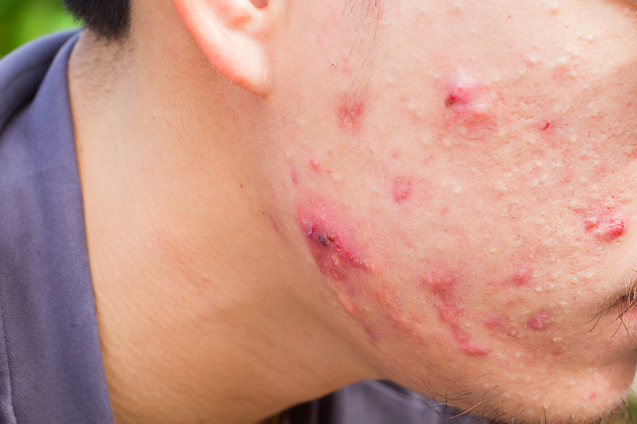 Acne and Vitamins A & E