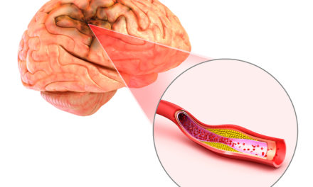 Depression Increases the Risk for Stroke