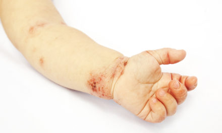 Infantile Eczema and Probiotics
