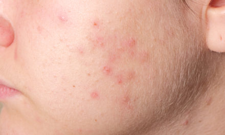Vitamins and Acne