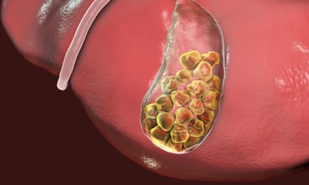 Vitamin C and Gallstones