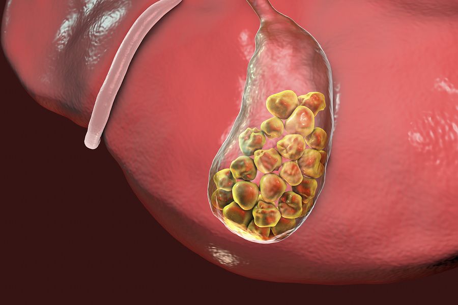 Vitamin C and Gallstones
