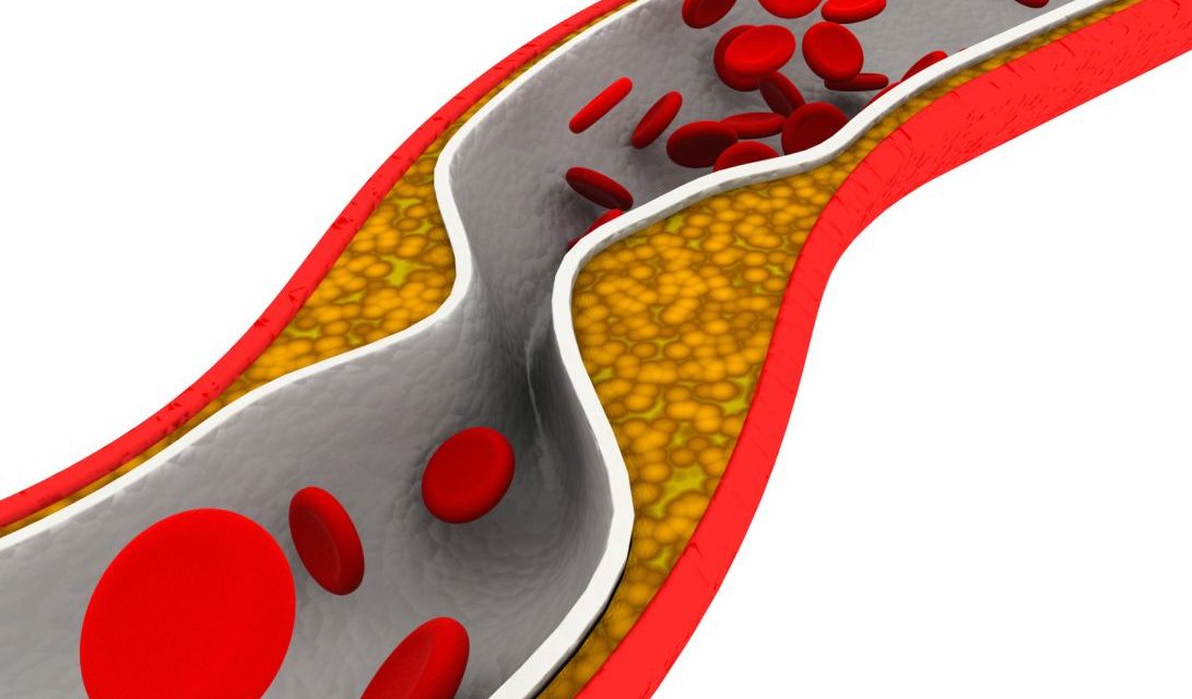 Trans Fatty Acids and Cardiovascular Disease