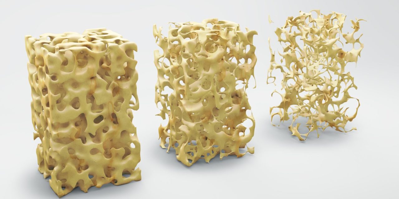 Improving Bone Mass in Celiac Disease Patients