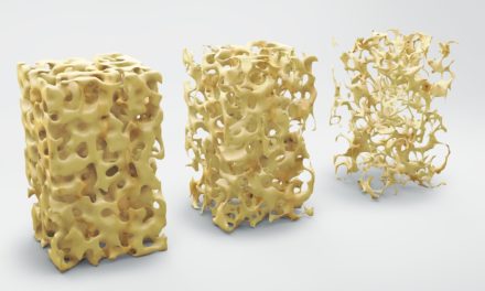 Improving Bone Mass in Celiac Disease Patients