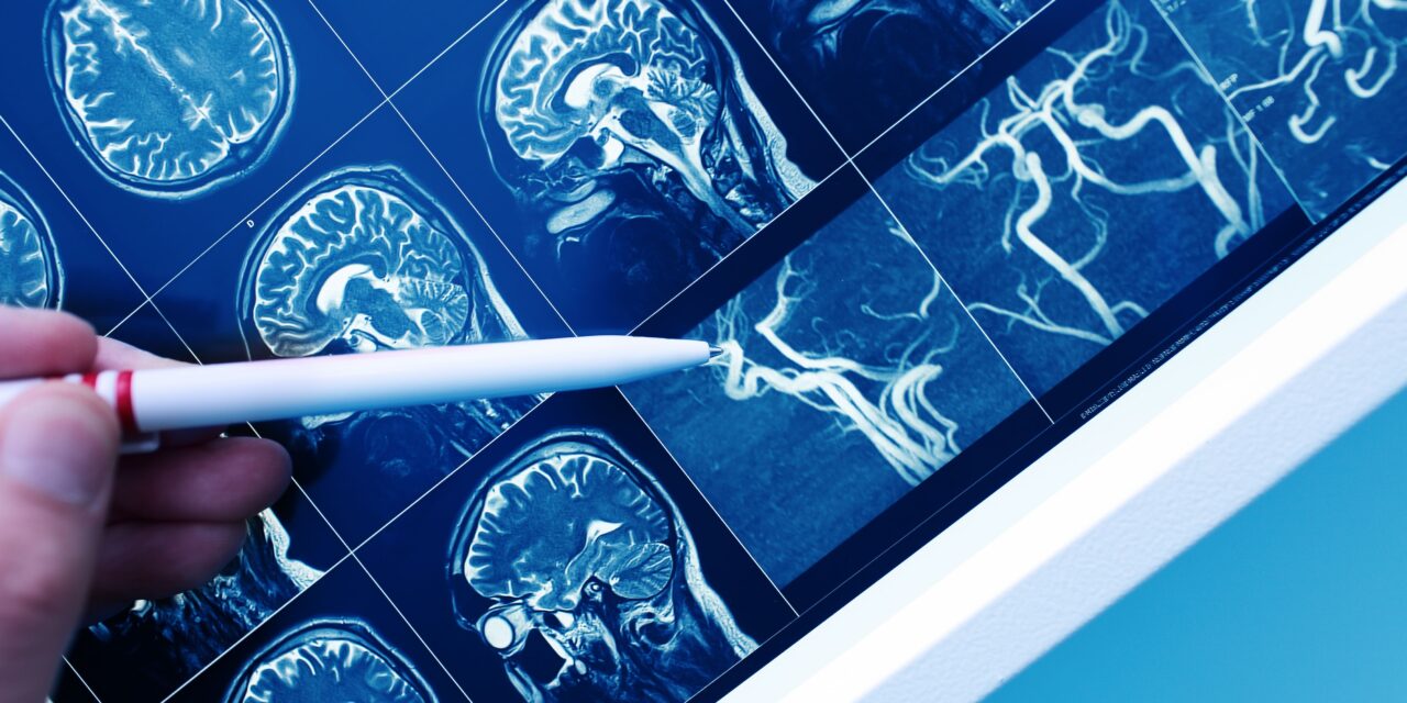 Benfotiamine and Brain Health: How Vitamin B1 May Help Protect Against Alzheimer’s Disease