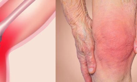 Niacinamide for Joint Pain and Mobility